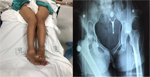 1: Patient with hip flexion and internal rotation and X-ray with traumatic bilateral posterior hip dislocation.