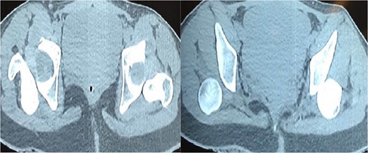 CT-Scan show bilateral posterior hip dislocation without evidence of fracture or articular fragments.