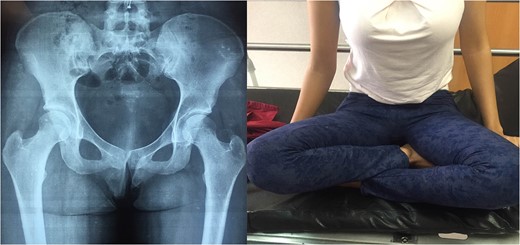 After closed reduction-Hip abduction and external rotation.