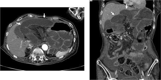 Preoperative CT scan revealed an internal hernia (arrow).