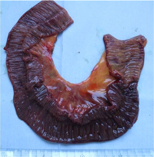 A picture of the resected strangulated small intestine.