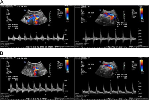 Comparison of duplex ultrasound of transplanted kidney in August 2015 compared to September 2015. Elevated velocities proximal and at the main renal artery anastomosis to 330 cm/s from 85.6 cm proximal to anastomosis (A) and 224 cm/s from 139 cm/s at the site of the anastomosis (B).