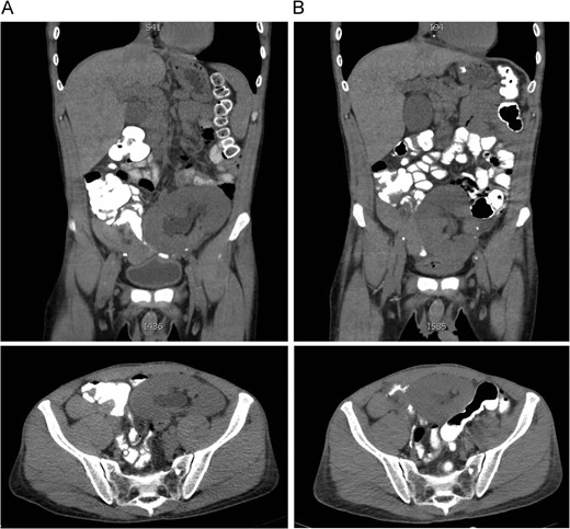 Comparison of CT scans obtained July 2015 (A) and August 2015 (B) showing migration of the transplanted renal allograft within the peritoneal cavity.