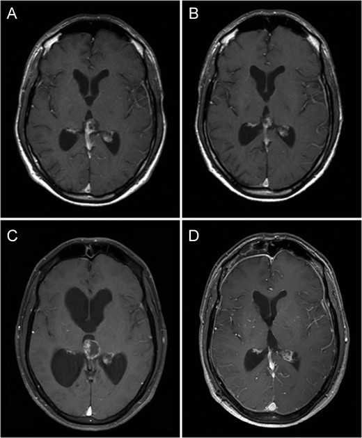 Fat saturated axial gadolinium enhanced T1 weighted MR Brain Image Series (A—July 2000, B—October 2003, C—July 2009 and D—November 2010). Image A demonstrates a heterogeneously enhancing lesion involving the pineal gland with enhancing solid as well as cystic components. Image B demonstrates a reduction in size of this lesion following radiation therapy. Image C demonstrates a prominent increase in the cystic component of the lesion associated with obstructive hydrocephalus. Image D demonstrates no residual tumour or contrast enhancement 1-year following surgery.