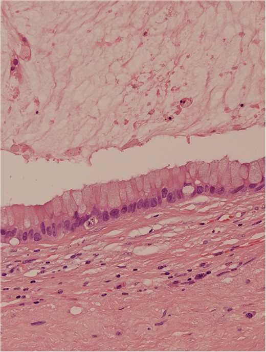 Haematoxylin and eosin stain demonstrated a mucin-containing cyst, lined by a partly detached columnar epithelium containing numerous goblet cells, surrounded by a dense, lightly inflamed fibrous stroma and a thin rind of calcified tissue probably representing residual pineal gland. The epithelium lining the cyst comprised cuboidal and columnar epithelial cells largely arranged as a monolayer, but with focal stratification, mild cytologic atypia and rare mitoses, but no malignant change. The cyst contained copious mucin, with an inflammatory and histiocytic reaction. Dystrophic calcification was present, both within the cyst and in the dense fibrous wall. Immediately peripheral to the main central cyst, there were a few smaller outpouchings into the stroma lined by epithelium of similar nature. No other germ cell elements were identified. The features were interpreted to represent mature cystic teratoma with only a monodermal tissue element (mucinous, cystic glandular element), with no other neoplastic germ cell component, most probably of pineal origin.