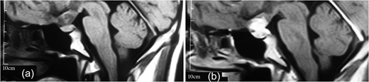 (a, b) MRI revealing a well-delineated round tumor 30 × 25 × 20 mm in diameter, T1W isointense and T2W hyperintense lesion located within the sella turcica and another dural-based lesion lying over the diaphragm sella extending to the planum sphenoidale. The intrasellar lesion showing a faint enhancement after contrast material injection but the suprasellar lesion has a bright enhancement.