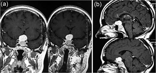 MRI showing (a) an intrasellar lesion isointense in T1W and T2W images enhancing homogenously and mildly after contrast material injection and (b) a suprasellar lesion 3 × 3 × 2 cm in diameter with the same intensity in T1W and T2W images which enhanced notably after contrast material injection.