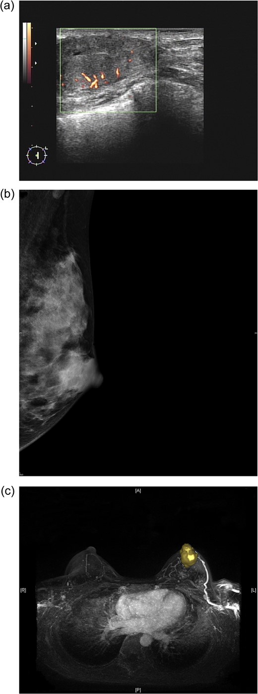 (a) Sonogram of the left breast reveals a 3.5-cm hypoechoic lesion with increased vascularity in the 2 o'clock/1-cm region. (b) Mammogram (mediolateral-oblique view) of the left breast shows a well-defined sharply circumscribed mass. (c) A maximal intensity projection magnetic resonance imaging image of the left breast revealed a 4.0-cm well-defined tumour with an engorged drainage vein beneath the nipple areolar complex region.