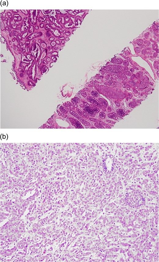 (a) Preoperative CNB (low-power field). The upper left tissue shows a complex glandular growth pattern in the fibro-myxomatous stroma. The lower right tissue shows DCIS in solid and cribriform patterns. (b) Postoperative final pathology (high power field). Grade II infiltrating ductal carcinoma characterized by nesting to glandular structure with intermediate-sized nuclei and rare mitotic figures.