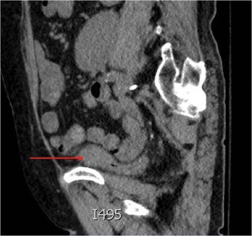 Saggital view of a mass at the dome of the decompressed bladder.