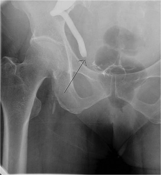 Aterograde nephrostogram demonstrating the obstruction at the ureterovesical junction.
