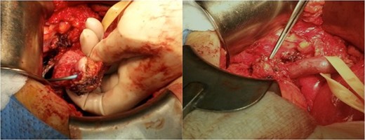 Intraoperative images depicting the tumor at the ureterovesical junction.