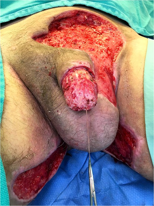 Following surgical debridement.
