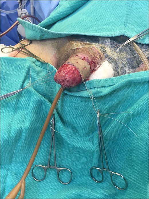Following full thickness skin grafting (dorsal aspect).