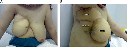 (A, frontal) and (B, lateral) Final result, 4 months post-operative, after right breast reconstruction using combined TRAM flap and LDMF.