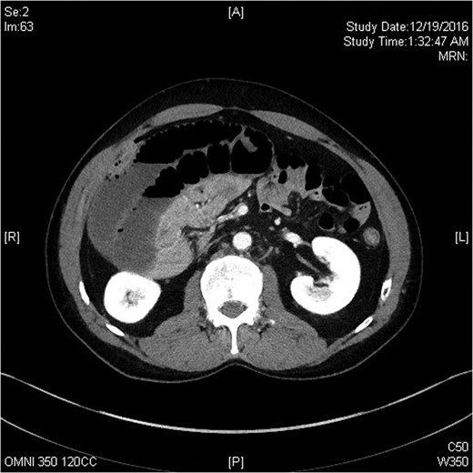 Computerized tomography scan of the abdomen in axial view demonstrating small bowel volvulus.