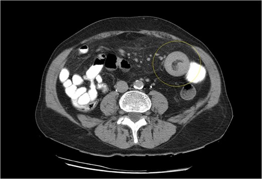CT scan demonstrating the typical ‘doughnut’ sign of bowel intussusception.