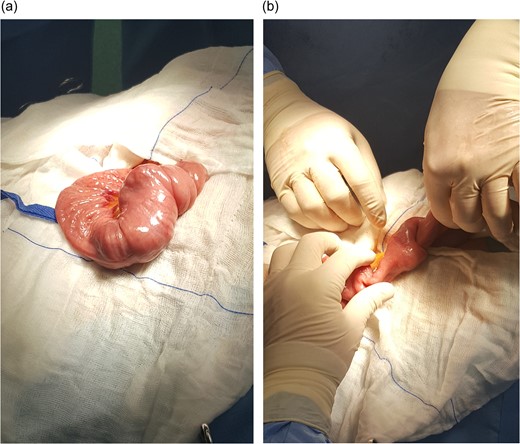 (a, b) Small bowel intussusception located in the proximal jejunum.
