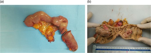 (a, b) Excised specimen demonstrating two NECs responsible for the intussusception.