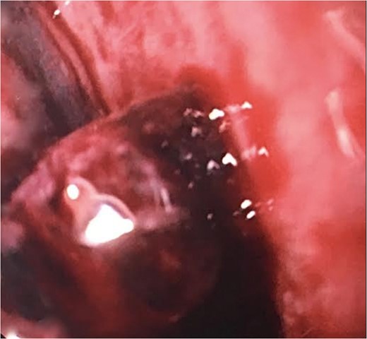 EGD showing adherent clot in the mid-portion of esophagus.