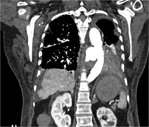 CT scan chest/abdomen/pelvis coronal view. Thoracic pseudoaneurysm distal to the left subclavian artery take off and proximal to the origin of the celiac artery.