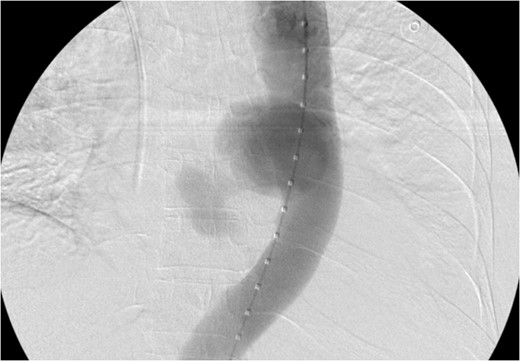 Aortogram showing active extravasation.