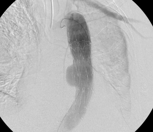 Aortogram showing successful deployment of covered stent graft.
