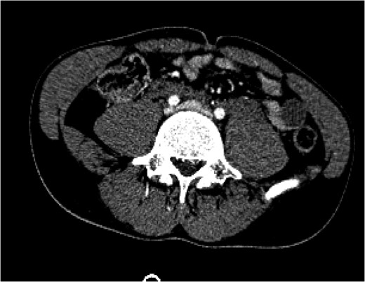 A CT of the abdomen and pelvis taken on arrival (Day 1) showed a blush of contrast at the bifurcation of the common iliac veins.