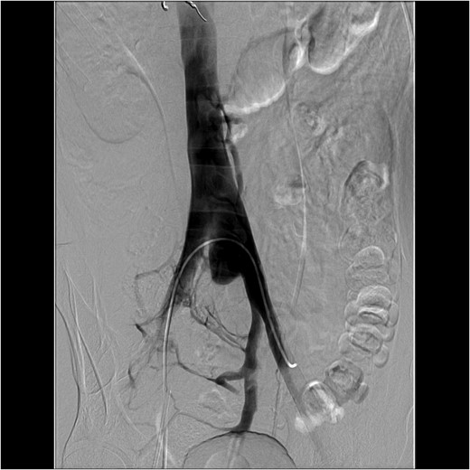 An interventional radiology angiogram and venogram on Day 1 showed a 2.8 cm pseudoaneurysm in the proximal portion of the left common iliac vein. There was no involvement of the base of the IVC and no active extravasation.