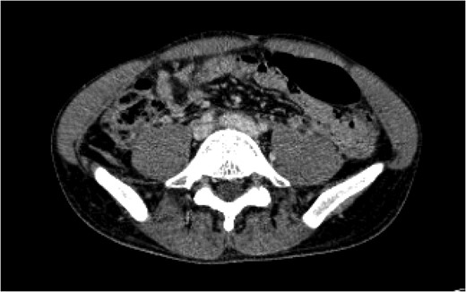 A CT angiogram of the chest with and without contrast on Day 16 showed resolution of the pseudoaneurysm in the proximal left common iliac vein with clear flow at the IVC bifurcation.