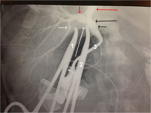 Intraoperative cholangiography. Short white arrow: the origin of the aberrant bile duct from the RPSD. Long white arrow: the stump of the cystic duct. Short red arrow: RHD. Long red arrow: LHD. Long black arrow: CHD. Short black arrow: CBD. Forceps 1 holds the stump of the aberrant bile duct. Forceps 2 holds the stump of the cystic duct. Forceps 3 blocks the CBD for the intraoperative cholangiography.