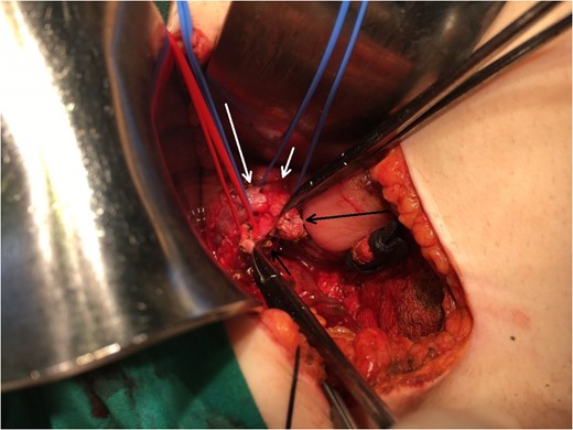 Operating field after the removal of the gallbladder. Short black arrow: the stump of the aberrant bile duct. Long black arrow: the stump of the cystic duct. Long white arrow: CHD. Short white arrow: CBD.