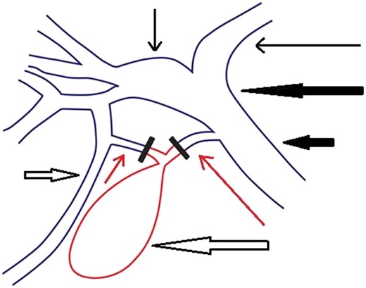 Schematic representation of the patient's biliary tree. The part of the extrahepatic biliary tree that was removed during the operation (the gallbladder, part of the cystic duct and part of the aberrant duct) is illustrated with red color. Short thin red arrow: the aberrant bile duct. Long thin red arrow: cystic duct. Long thick white arrow: gallbladder. Short thick white arrow: RPSD. Short thin black arrow: RHD. Long thin black arrow: LHD. Long thick black arrow: CHD. Short thick black arrow: CBD.