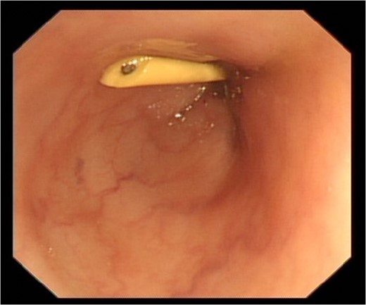 Connecting tube visible at colonoscopy.