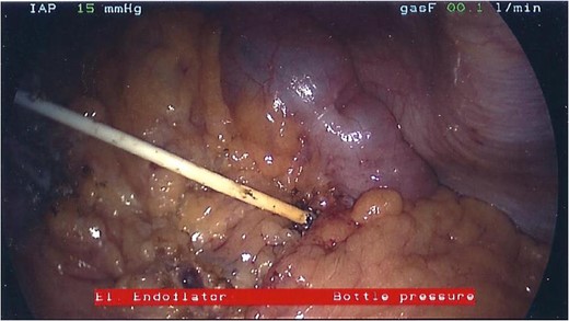 Connecting tube eroding into colon, seen at laparoscopy.