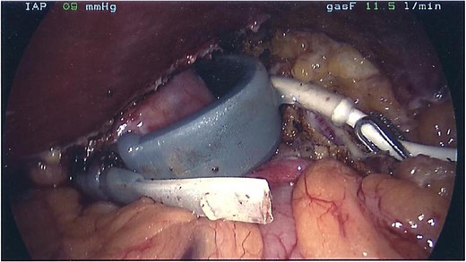 Gastric band at laparoscopy.