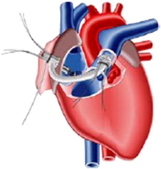 Schematic presentation of the Impella Right Direct implantation.