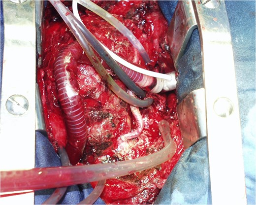 The Impella Right Direct implanted.