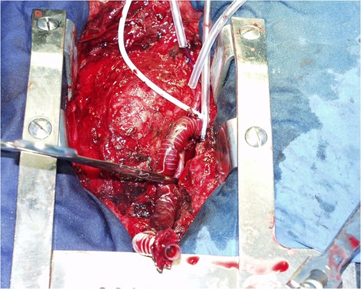 Removal of the outflow tip of the device.