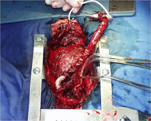 Removal of the inflow tip of the device.