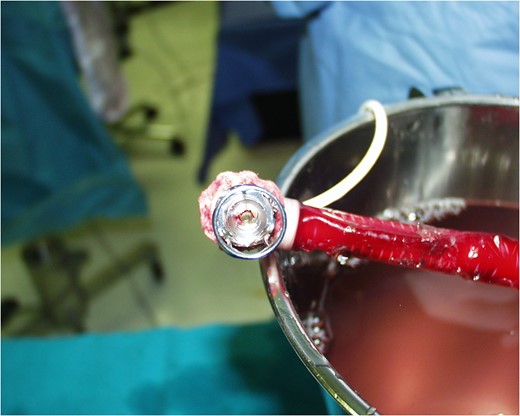 The outflow tip of the Impella device.