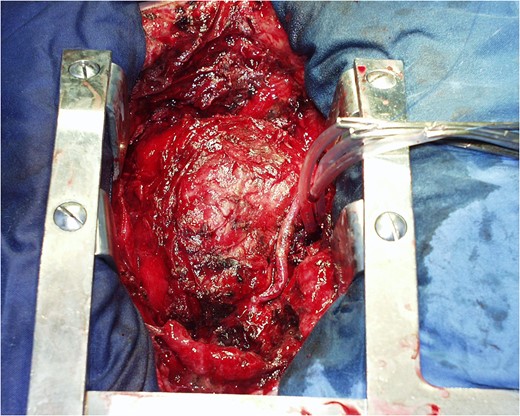 After removal of the device.