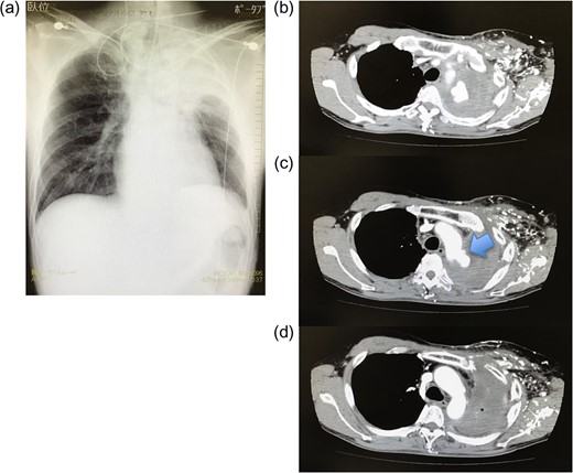 (a) Chest radiography on admission. Consolidation is observed in the left upper lobe. (b–d) Enhanced computed tomography after admission. Extravasation of contrast medium is observed in the distal aortic arch. The entry point is identified distal to the subclavian artery (arrow).
