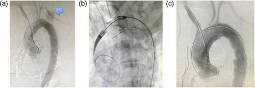 (a) Intraoperative aortography. Extravasation of contrast medium is observed (arrow). Additionally, the site of rupture could be precisely identified. (b) Intraoperative aortography. With the common femoral artery approach, stent grafts are placed between just distal to the left common carotid artery and the distal aortic arch. To achieve sufficient length of the proximal landing zone, the left subclavian artery is covered intentionally. (c) Postoperative aortography. Extravasation of contrast medium is not seen and there is no endoleak.