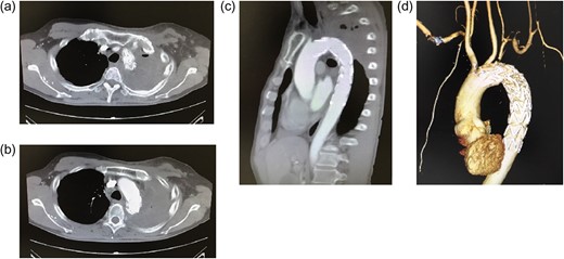 (a–c) Postoperative enhanced computed tomography (CT) (a, b: axial images; c: sagittal image). (d) 3D CT. The aortic rupture is confirmed to be effectively treated. There is no extravasation of contrast medium or endoleak. The origin of the left subclavian artery is occluded. Distal to the occluded site, the subclavian artery is perfused via collateral communications. The left vertebral artery is patent.