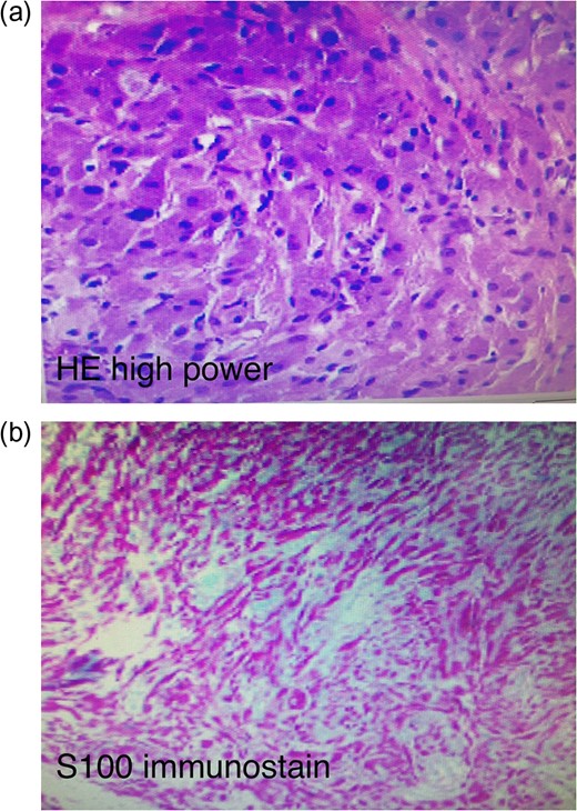 (a) Haemotoxylin and eosin stain of the pathological specimen. (b) S100+ immunostain of the pathological specimen.
