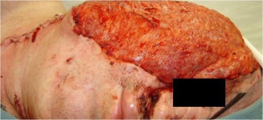Intraoperative image after reconstruction of defect with a right latissimus dorsi microvascular free muscle flap.
