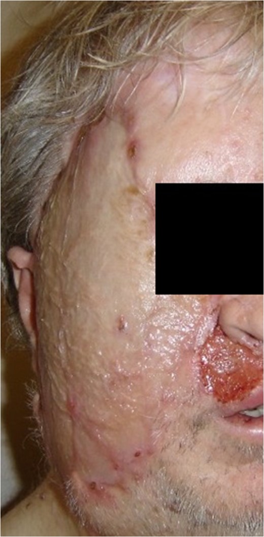 Three months post-operative image.