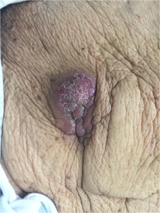 Right upper quadrant lesion overlying intra-abdominal insertion site of ventriculoperitoneal shunt.