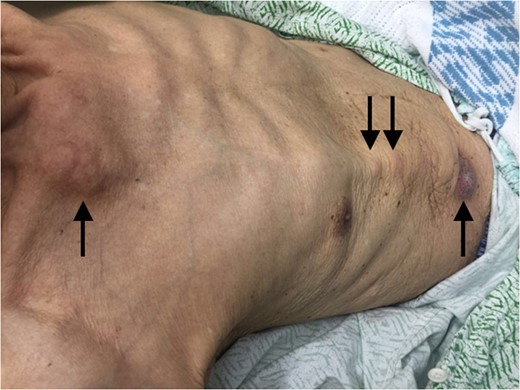 Multiple subcutaneous nodules tracking along the ventriculoperitoneal shunt.